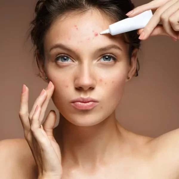 Acne Treatment - 6 Sessions – 60 mins